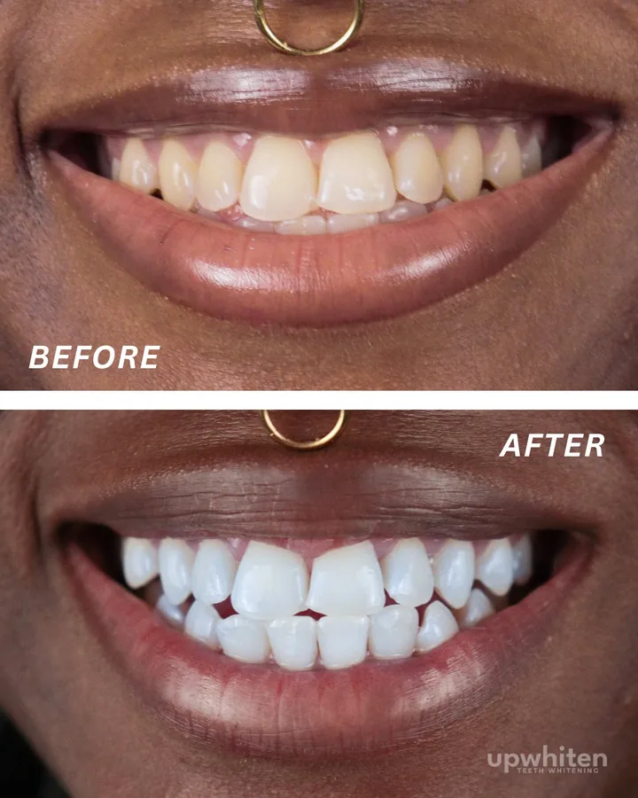 Before and after number 4, shot under the same light at every visit