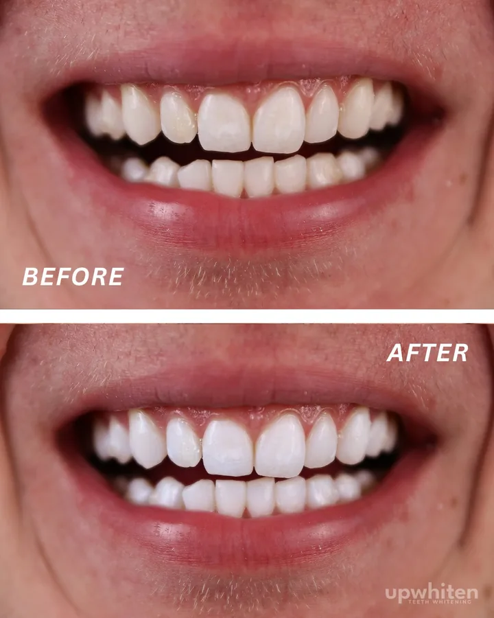 Before and after number 11, shot under the same light at every visit