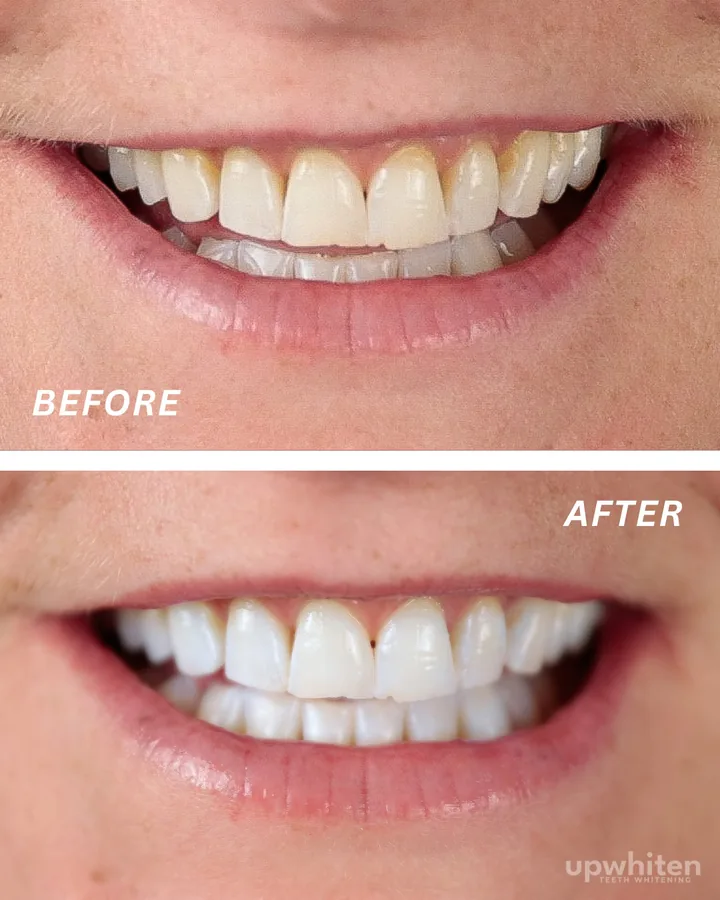 Before and after number 5, shot under the same light at every visit
