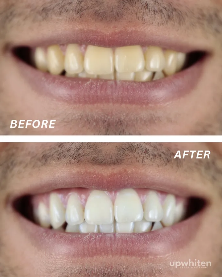 Before and after number 6, shot under the same light at every visit
